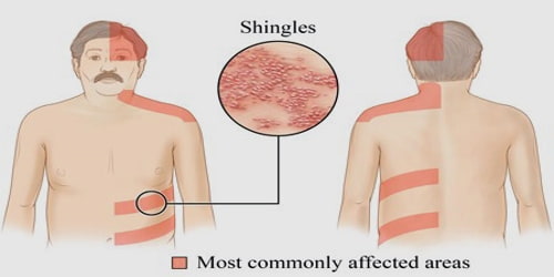 Shingles Causes Symptoms And Complications Assignment Point