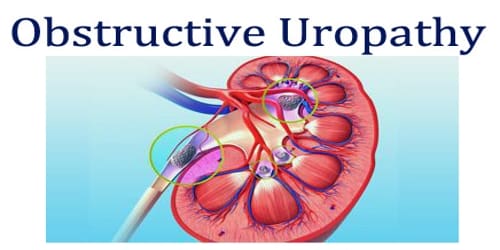 Obstructive Uropathy Assignment Point