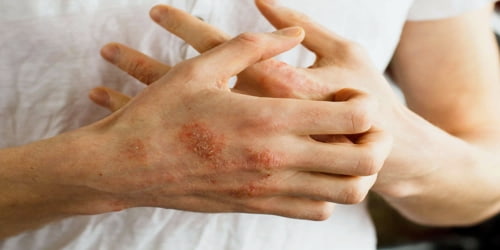 signs of latex mattress allergy