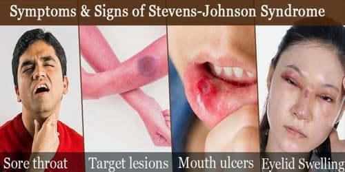 stevens-johnson-syndrome-symptoms-diagnosis-treatment-and