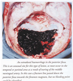 Intracranial Hemorrhages