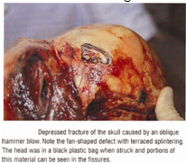 Skull Injuries