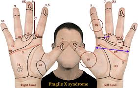 Assignment on Fragile X syndrome