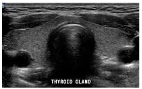sonographic appearance