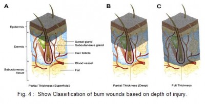 Classification of burn wounds based on depth of injury