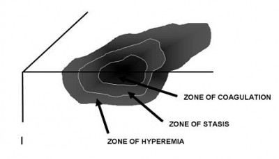 Zones of injury