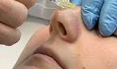 Cosmetic Surgery of Nose
