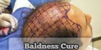 Surgical Cure for Baldness