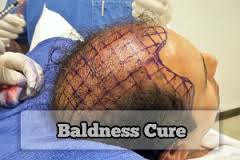 Surgical Cure for Baldness