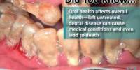 Poor Dental Hygiene May Account for Poor Health