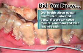 Poor Dental Hygiene May Account for Poor Health