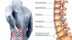 Common Back Pain Treatments