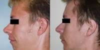 The Attractiveness of Chin Augmentation