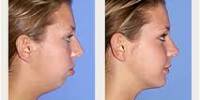 Four Things to Judge with Chin Surgery