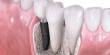 Common Questions about Dental Implants