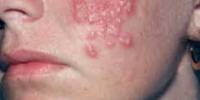 Natural Cures for Herpes Simplex