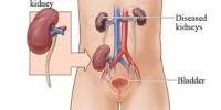 Kidney Transplant Surgery and Treatment