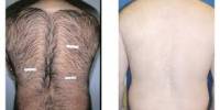 Advantages and Disadvantages of Laser Hair Removal