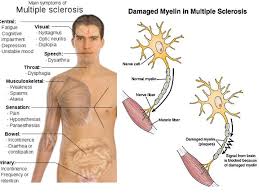 Natural Cures for Multiple Sclerosis