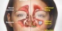 Some Speedy and Simple Sinusitis Remedies