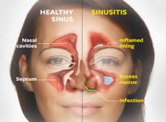 Cure Sinusitis Naturally