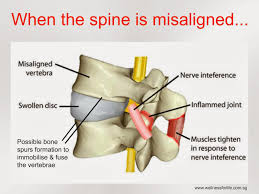 Chiropractor Treatment for Spine Misalignment
