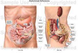 Signs of Abdominal Adhesions
