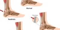 How to Avert Achilles Tendon Injuries