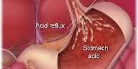 Explain the Causes of Reflux