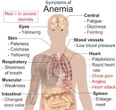 Natural Treatment for Anemia Symptoms