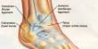Accurate Care of an Ankle Sprain