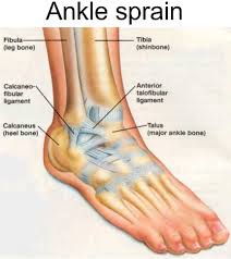 Accurate Care of an Ankle Sprain