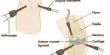 Effects of Arthroscopy Surgery
