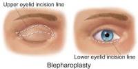 Benefits of Blepharoplasty