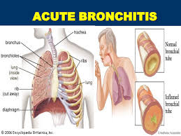 Explain Bronchitis Preventions
