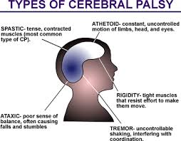 Causes of Cerebral Palsy Symptoms in Children