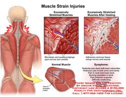 Causes of Chronic Muscle Pain