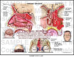 Chronic Sinusitis is a Difficult Stage of Sinusitis Infection