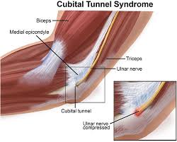Causes and Treatment of Cubital Tunnel Syndrome
