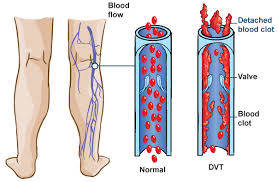 Major Facts for Deep Vein Thrombosis