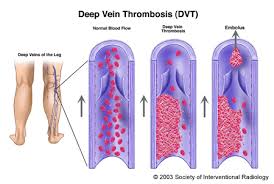 Explain Deep Vein Thrombosis