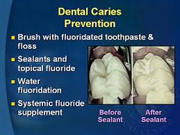 Importance of Dental Cavity Prevention