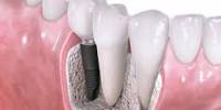 Power of Dental Implants