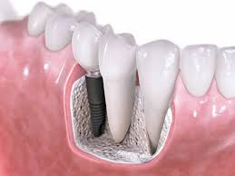 Power of Dental Implants