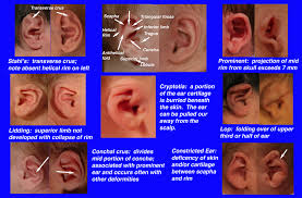 General Ear Deformities in Children