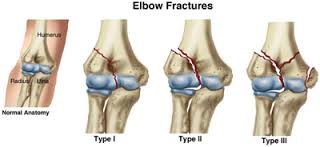 Causes of Wrist and Elbow Fractures