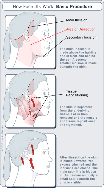 Procedure of Facelift Surgery