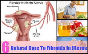Explain Cures for Fibroids