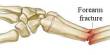 Familiar Forearm Fractures in Children