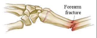 Familiar Forearm Fractures in Children